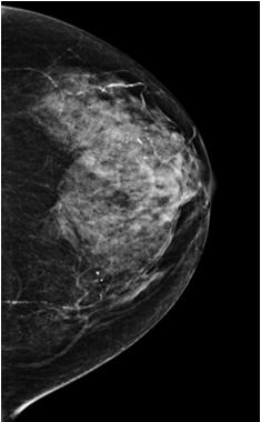 the same compression are completely co-registered Image Reconstruction Image reconstruction is computing high-resolution images whose planes are parallel to the breast support plates Reconstructed