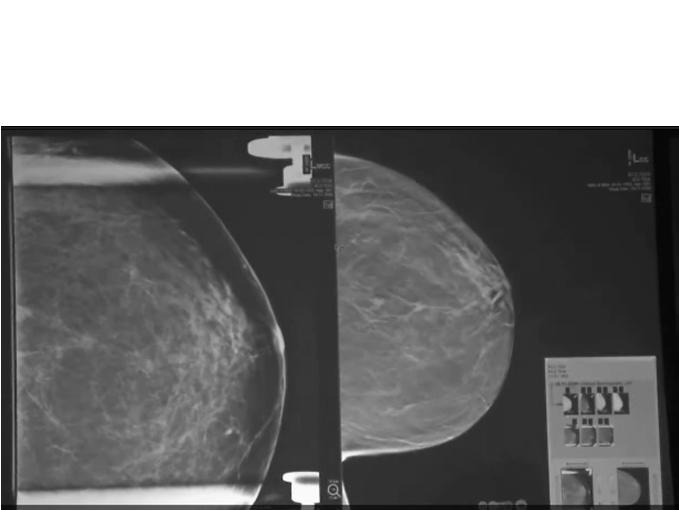 Co-registration of 2D & 3D breast images For Technologists 2D and 3D scan acquired with a single positioning/view Workflow is same as FFDM; no learning curve For Patients The clinical trials