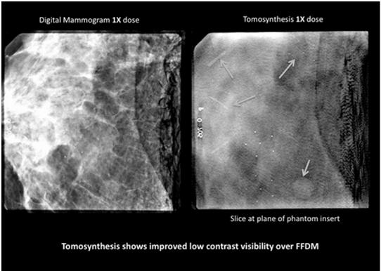 objects are reduced Even at 4x a conventional dose the digital mammogram (middle) shows inferior low contrast visibility to a tomosynthesis (right) using ¼ the dose For Radiologists