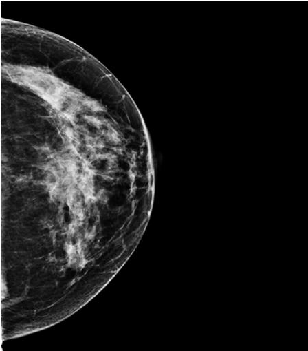 Mammography Image next to one slice of a 3D Image Set Why is tomosynthesis going to