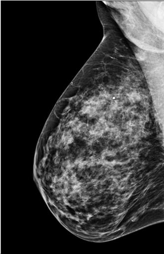 A 2D Mammography Image with RMLO a
