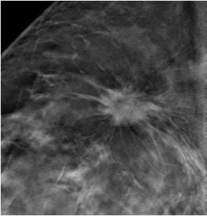 up A 2D Mammography Image with a