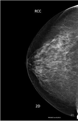 breast structures overlapping More