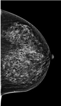 Angular Range 1mm slices: Number of slices dependent upon compressed breast thickness that are reconstructed from projection images 5cm compressed breast 50 1mm slices + 5 Always adds 5 to clear the