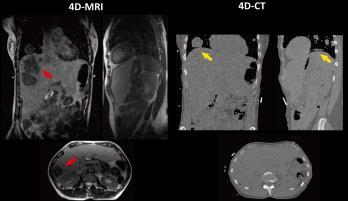 Outline 4 RT applications of dynamic MRI Basics of fast MRI Recent advances in accelerated MRI acquisitions Temporally resolved CT and MR images 5 Internal organ motion is of tremendous interest to