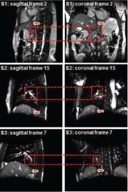 Limitations of D dynamic MRI 16 Cannot differentiate in-plane