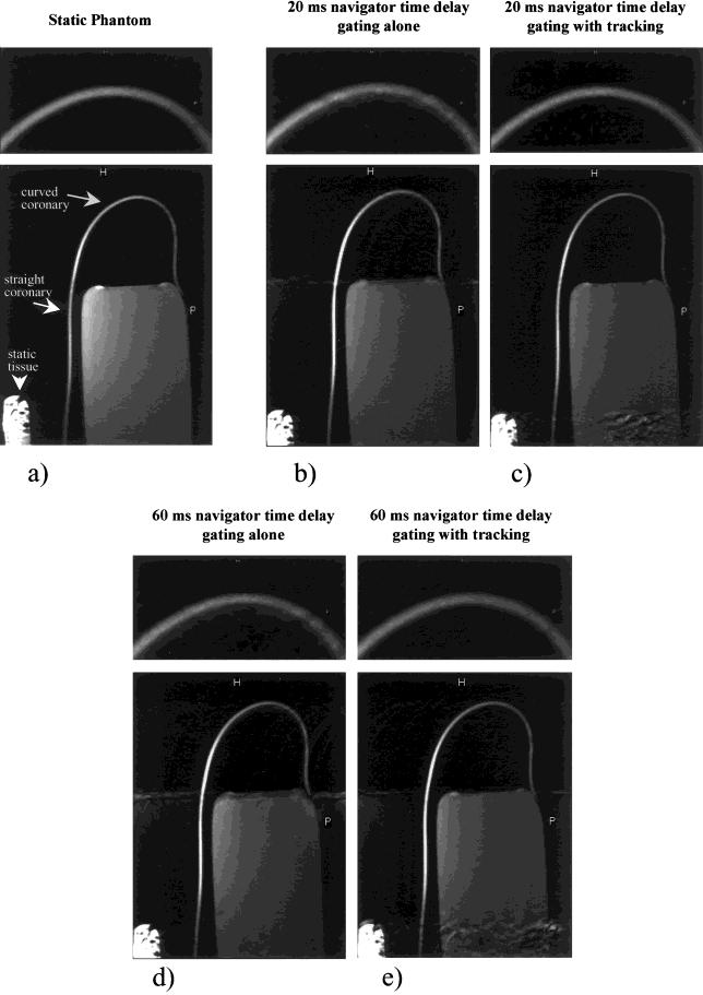 314 Spuentrup et al. Figure 3. 3D coronary MRA (slice thickness, 1.5 mm; in plane resolution, 0.5 0.5 mm 2 ) static (a) and with moving phantom (b i) for different navigator time delays.