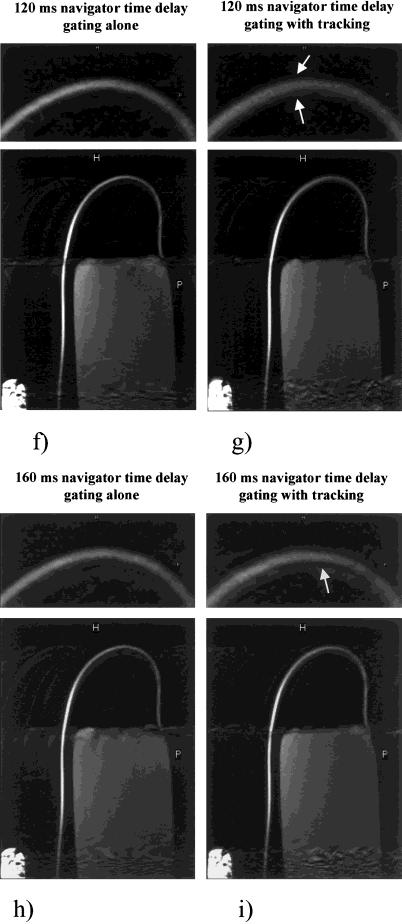 Navigator Timing on 3D Coronary MRA 315 Figure 4.