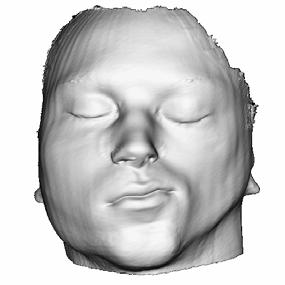 Initially a PDM derived from the normal Bosma datasets was used to guide the warping of the face globally to demonstrate variations within the populations studied.