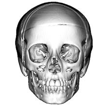 Mode 1 Mode 2 Fig 4. Normal skull warped along the first 2 modes of variation in the normal population (from the original dimensions on the left to 2 standard deviations of the warp on the right).