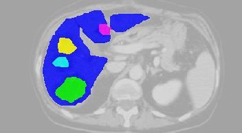 (a) input image, user scribbles - liver (blue) and tumors (green, yellow, cyan, magenta) along with segmentation results, (b) energy vs. time plot (top) with zoom in the (bottom).