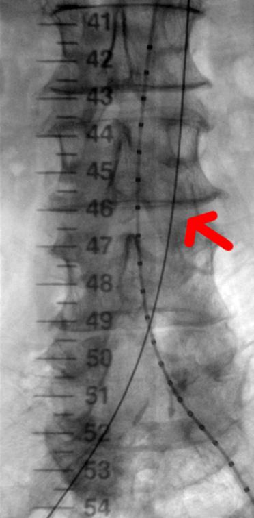 A typical surgeons view at the various time points from the fluoroscopy b) with the guide wire only c) showing the undeployed stent d) the deployed stent.
