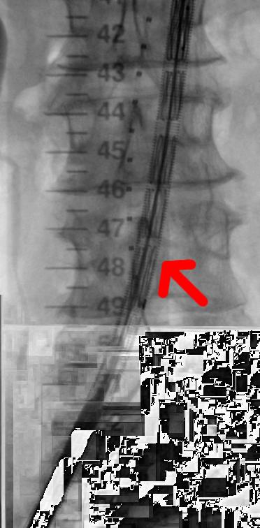 (a) P that can map 3D positions in the CT scan to 2D fluoroscopy positions, or given a 2D point on a fluoroscopy image u can define a corresponding 3D line through the CT scan L(u, P).