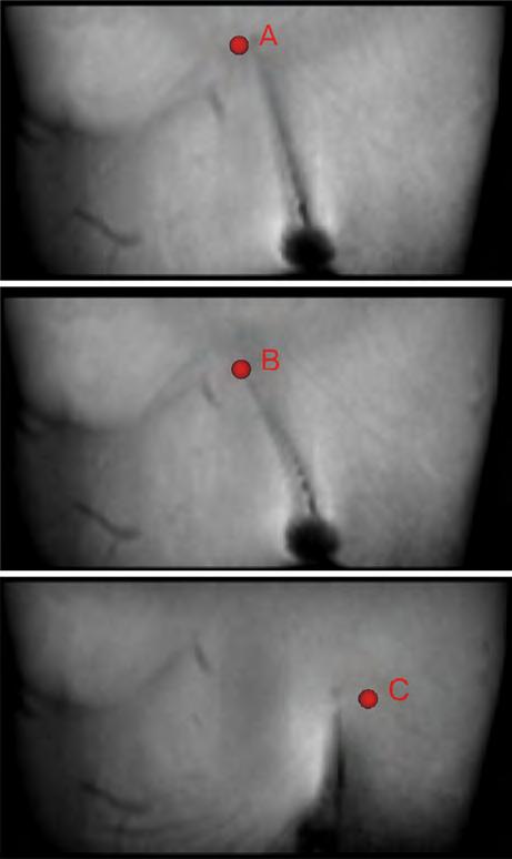 Ex vivo tissue results showing three different selected targets (red spheres) and the corresponding needle trajectory and needle tip location on axial TSE