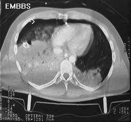 Abdomen Pneumothorax (air between lung and