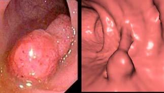 Comparison Left: A polyp seen with optical endoscopy. Right: View in virtual endoscopy.
