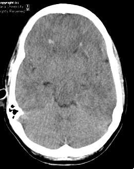A. Sisniega et al. (presented at RSNA 214) CBCT of Acute Brain Trauma Traumatic Brain Injury (TBI) 1.
