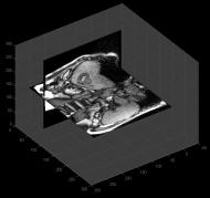 4D MRI Retrospective - 2D 4D