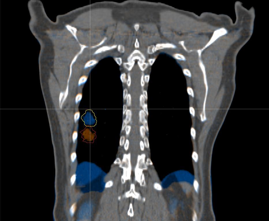 Organ / target motion: lung MRI Guidance Case study: lung patient, 10