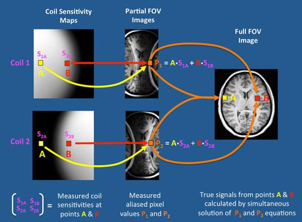 In short, if a scan is accelerated, the SNR decreases which means the image quality decreases. One way of accelerating MRI scans is by using a SENSE reconstruction.