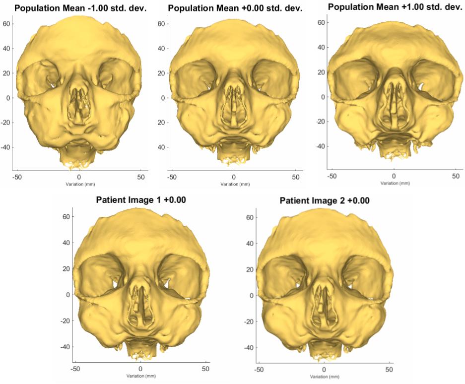 Figure 7. Top: Population variation in the skull model.