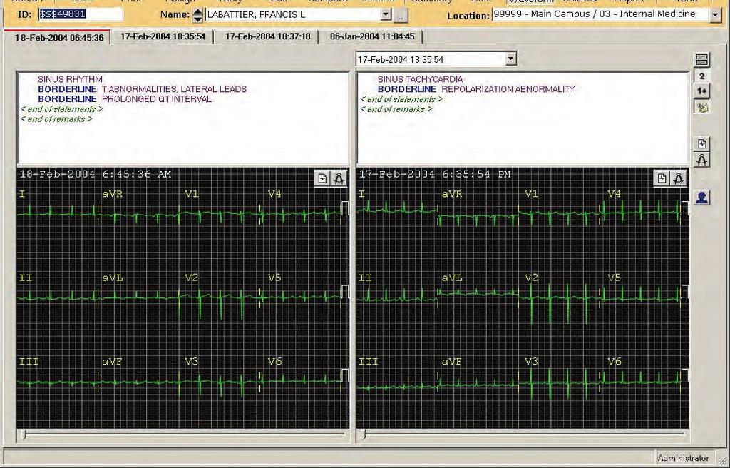 Viewing and Editing Reports Using Waveform View NOTE The Waveform view allows you to visually compare two ECGs on the same screen, as well as focus in greater detail on the waveforms for a single ECG.