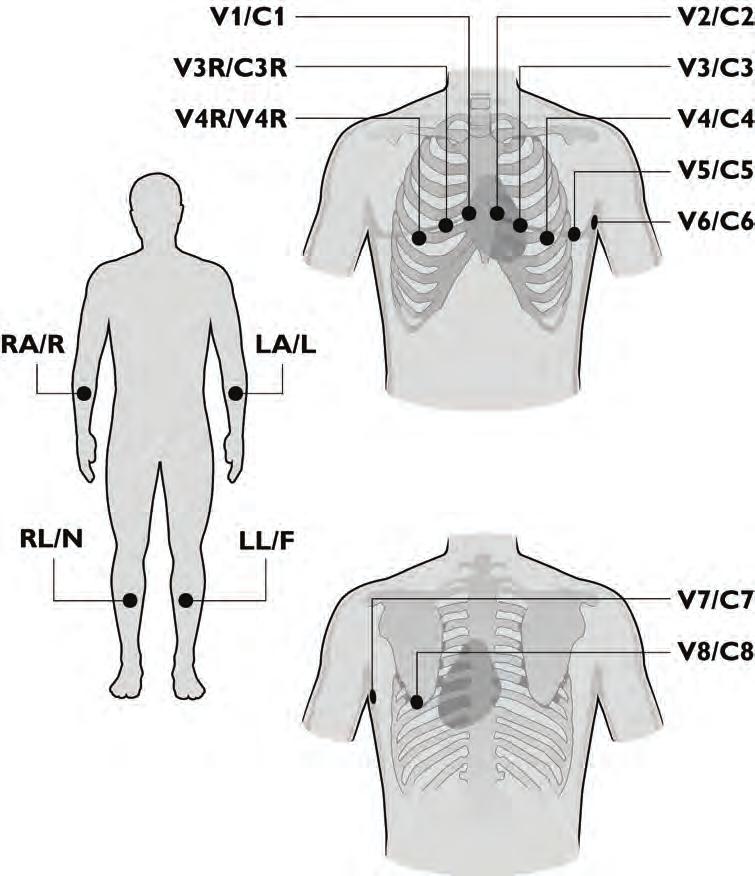 About Clinical Reports Extended Leads: V3R, V4R, V7, and V8 (Balance) The V3R, V4R, V7, and V8 lead locations are positioned to investigate the right and posterior walls of the heart for both