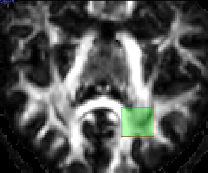 4 Discussion We have introduced a new set of tools for processing and interactive visualization of diffusion MRI datasets.