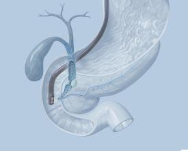A total system for complex procedures The number and importance of biliary and pancreatic procedures is on the rise.