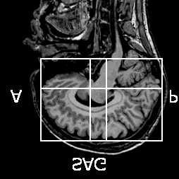 Figure 1: Figures 2a and 2e present two sagittal slices from one of the data sets. For a detailed description of the intermediate segmentation results see section 2.