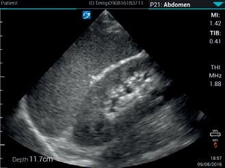 Upper Quadrant Spleen and Kidney L38v