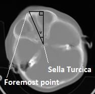 A B C Figure 13. Shows how the angles used for rotaion are defined. A) Shows a transversal slice where the foremost point and the middle of Sella turcica are chosen.