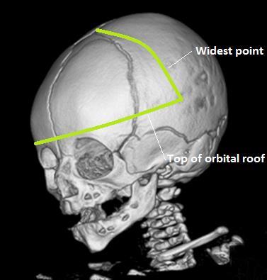 Figure 15. The area being studied is defined by the top of the orbital roof and the widest point of the skull.