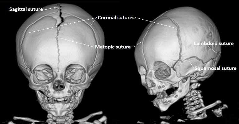 1. INTRODUCTION The skull of a newborn child consists of several different bones separated by sutures.