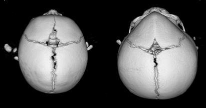 Figure 2a Figure 2b Fig. 2a shows a normal skull with a wider and more flattened forehead. Fig. 2b shows the characteristic features of metopic synostosis, the triangular forehead and a midline bony ridge.