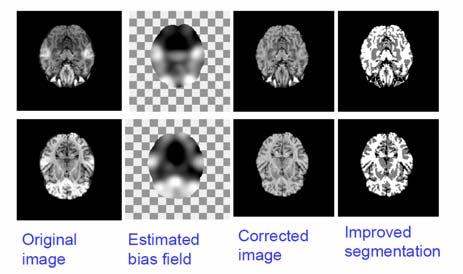 Partial Volume Segmentation Assumed so far that each voxel belongs to one single tissue type In reality, many voxels in brain MR images are