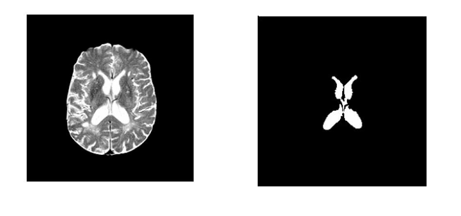 Region Growing A T-2 weighted MR brain image (left) and the segmented ventricles (right) using the region-growing method. Problems: 1.