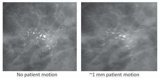 3.7 seconds in its commercially released Hologic Selenia Dimensions system. 2 Reduction of scan time to an absolute minimum is therefore critical, as patient motion as small as 0.