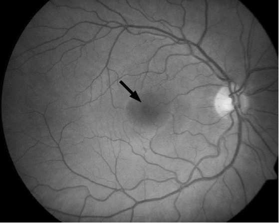 Fig 4: Location of the macula in the eye fundus retinography marked by a dark arrow.