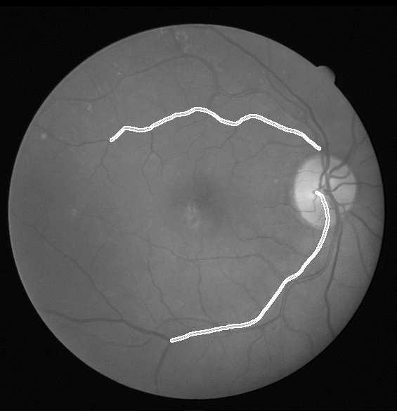 4.2 Macula Segmentation Once the candidate area containing the macula have been obtained, a correlation filter is applied to the region in order to locate the macula and so the fovea.