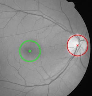 6 Conclusions In this work an algorithm for the precise localization and segmentation of the optic disc nerve head and localization of the macula has been presented.