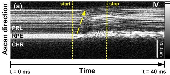 Time-resolved OCT data Effects originate in RPE / Bruch s membrane complex and expand to inner retina Signals linked to thermal expansion, thermal