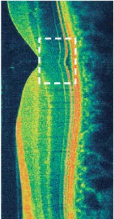 OCT: Basic principle Comparable with ultrasonic tomography