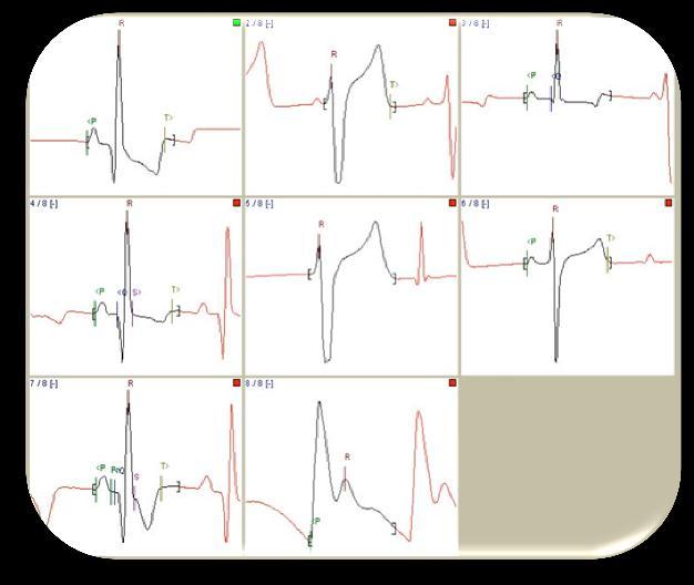 Waveforms Cardiac 12-Lead Electrocardiogram (ECG) General