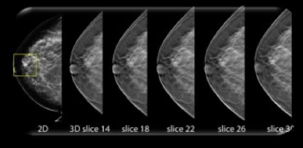 Mammography MG Digital Mammography X-Ray Breast Tomosynthesis High-resolution limited-angle tomography at mammographic dose levels.