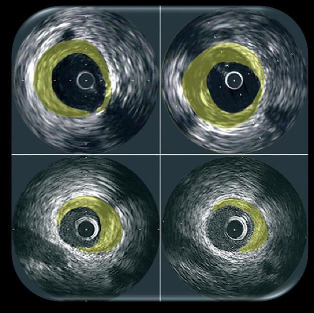 Intravascular Imaging Intravascular Ultrasound (IVUS) A catheter-based imaging modality with a miniaturized ultrasound probe.