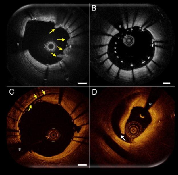 Intravascular Imaging Intravascular Optical Coherence Tomography (IVOCT) A high resolution catheter-based imaging modality upon low