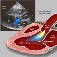 Stenosis Aortic valve does not open fully High velocity jets Aortic