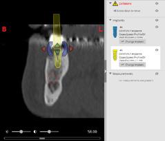 Modify the proposed plan Moving implants You can move the implant on any 3D or 2D view except the Panoramic X-ray view.