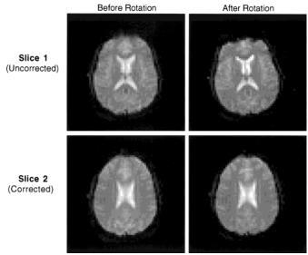 Coping with motion III: Prospective MC Prospective motion correction Ward et al 2000 MRM Motion correction is good, however: Even after all this, movement artifacts still remain